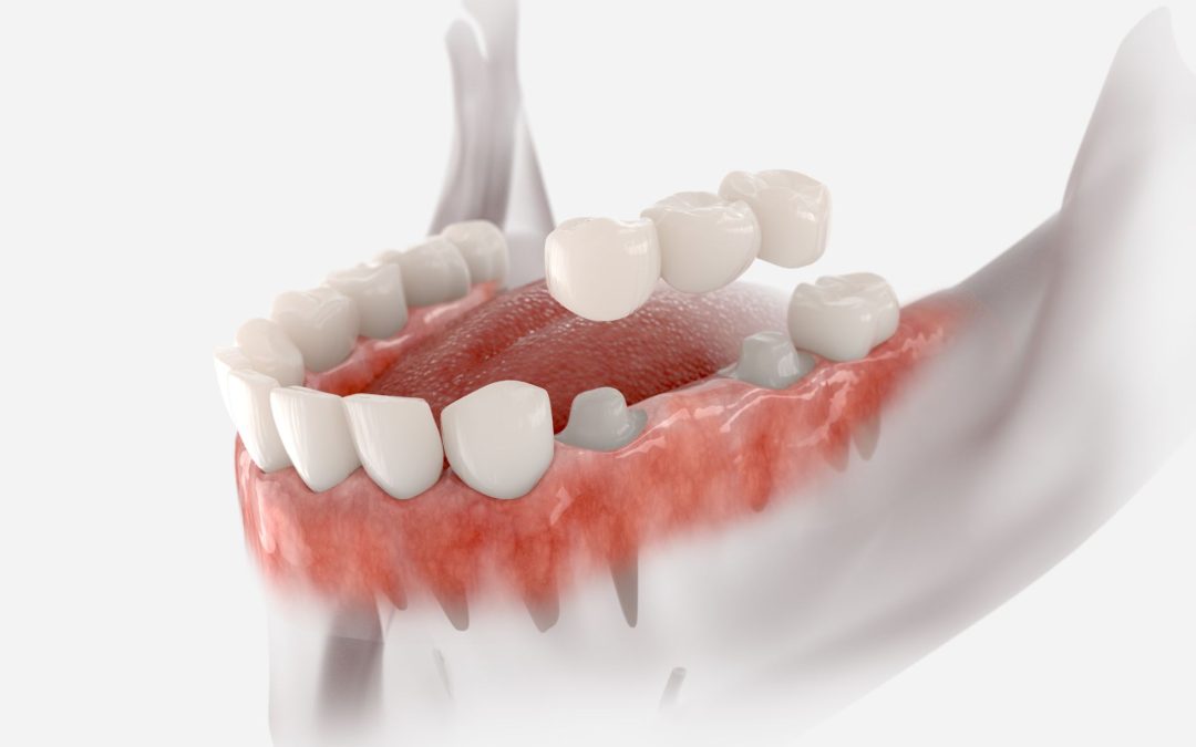 Porcelain Crowns and Bridges